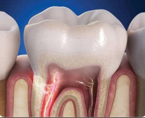 Чувствительные зубы – причины, как снять чувствительность зубов