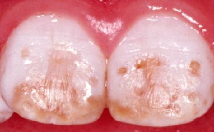 Причины и признаки гипоплазии эмали зубов