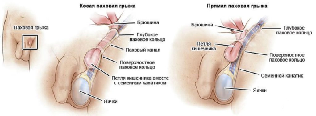 Паховые грыжи у детей