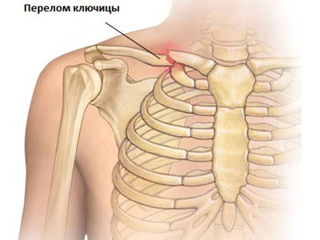 Перелом ключицы у ребенка - локализация травмы