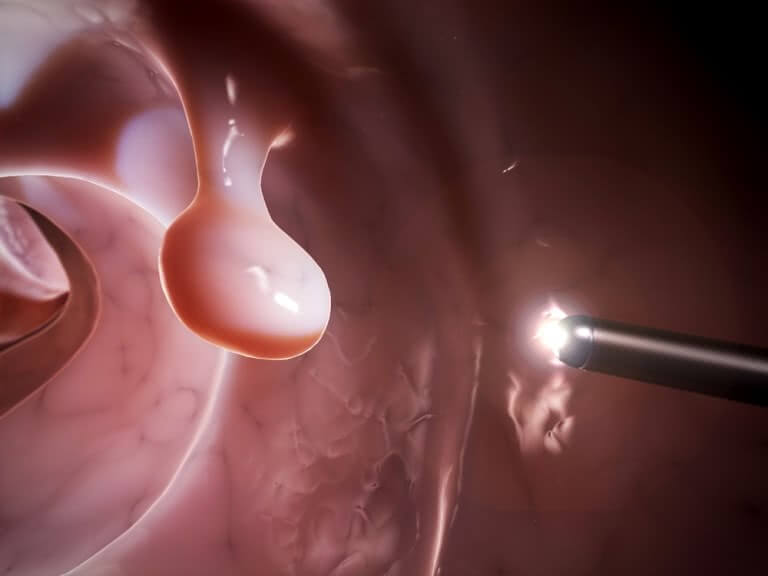 Удаления полипа в кишечнике - эндоскопическая операция