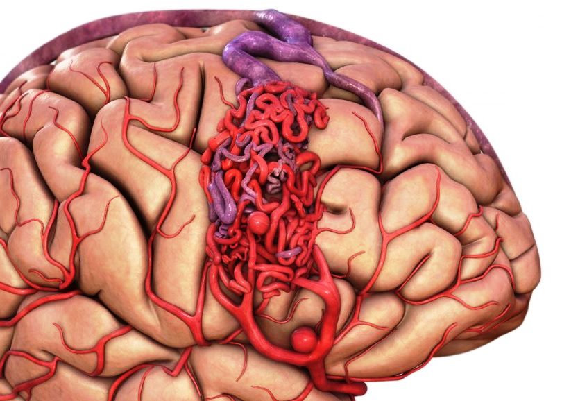 Причины ангиомы головного мозга