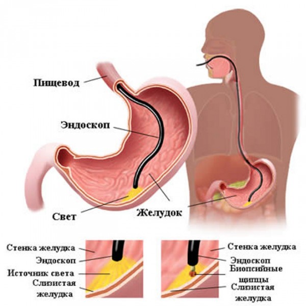 Эзофагогастродуоденоскопия