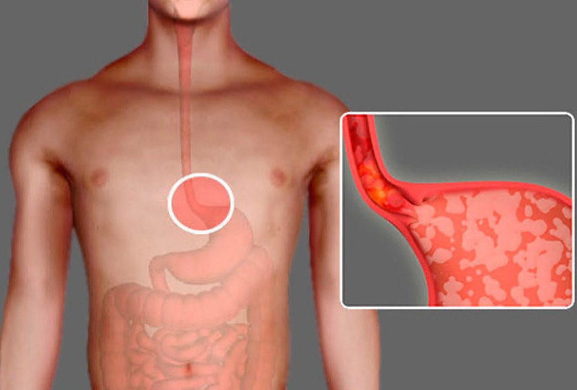 Недостаточность кардии желудка – симптомы ахалазии кардии пищевода