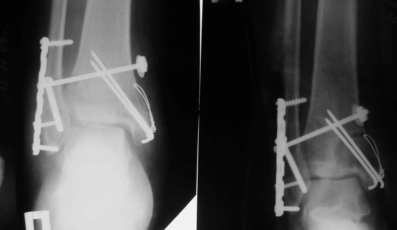 Перелом лодыжки - операция с пластиной