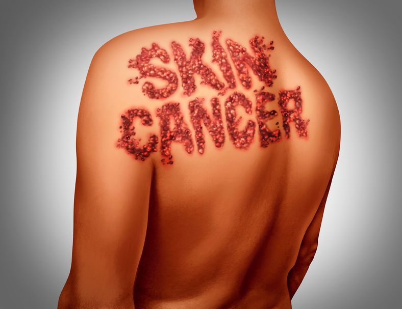 Причины и симптомы рака кожи - прогноз, лечение