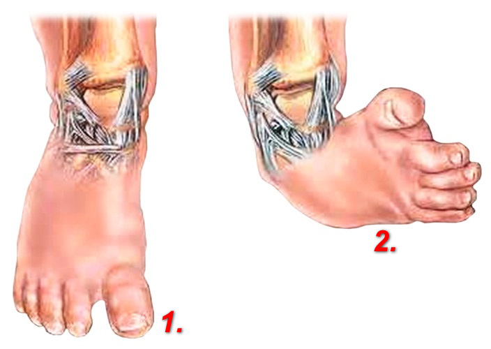 Признаки врожденной косолапости