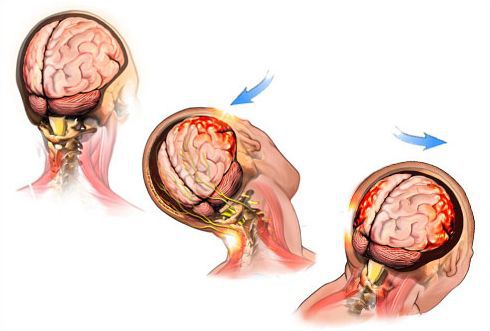Сотрясение мозга у детей