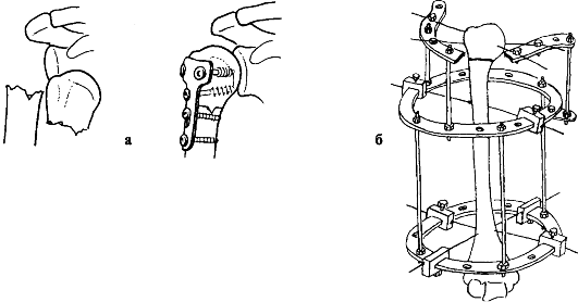 Открытая репозиция и фиксация при переломе плечевой кости