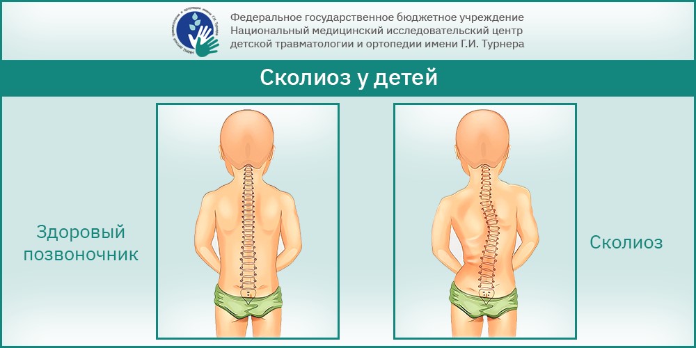 Лечение идиопатического сколиоза в России – каждой третьей операции можно избежать